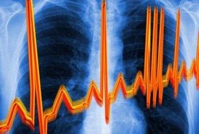 Arritmia cardíaca para osteocondrose