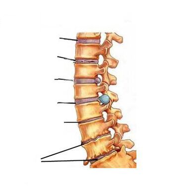 Como os osteocondrose se desenvolve