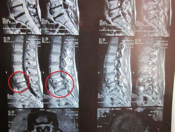 Diagnóstico de osteocondrose cervical