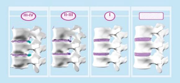 Estágios da osteocondrose cervical