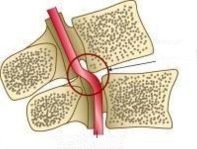 Síndrome da artéria Vail
