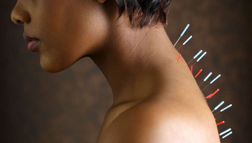 acupuntura com osteocondrose cervical