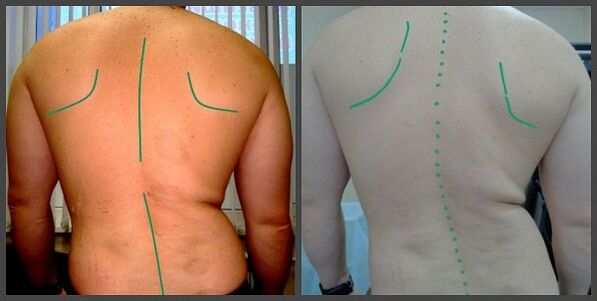 curvatura da coluna com osteocondrose