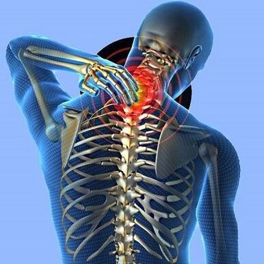 dor no pescoço com osteocondrose cervical