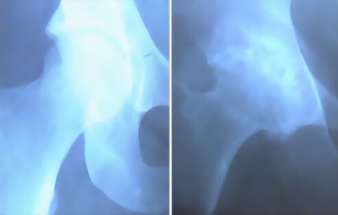 Escória de artrose da articulação do joelho