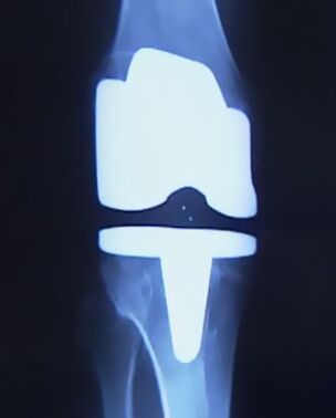 Picture X -Ray do joelho com uma prótese artificial após a operação para mudar a junta