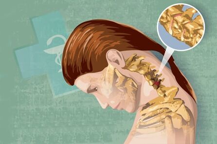 Sintomas reflexos de osteocondrose